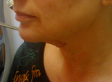neck 4 days after